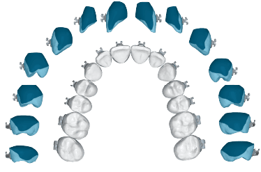 Braces 2 - Crow River Orthodontics in Hutchinson MN